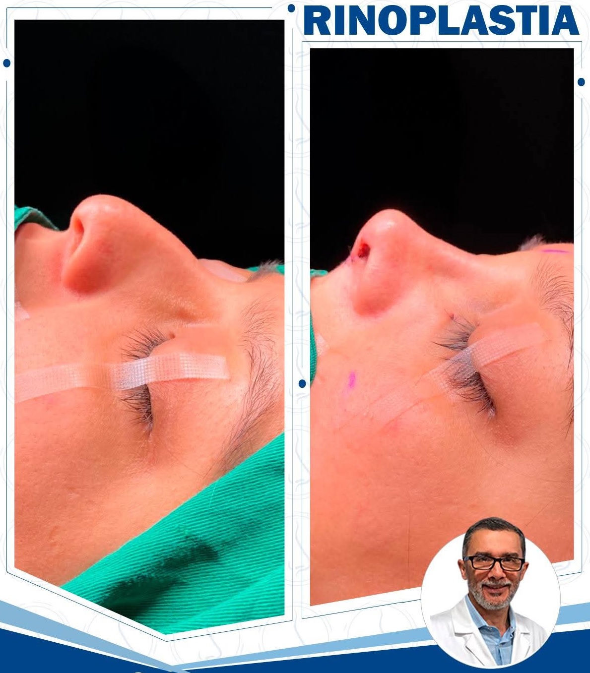 Rinoplastia Funcional