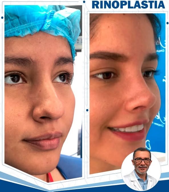 Rinoplastia Estética